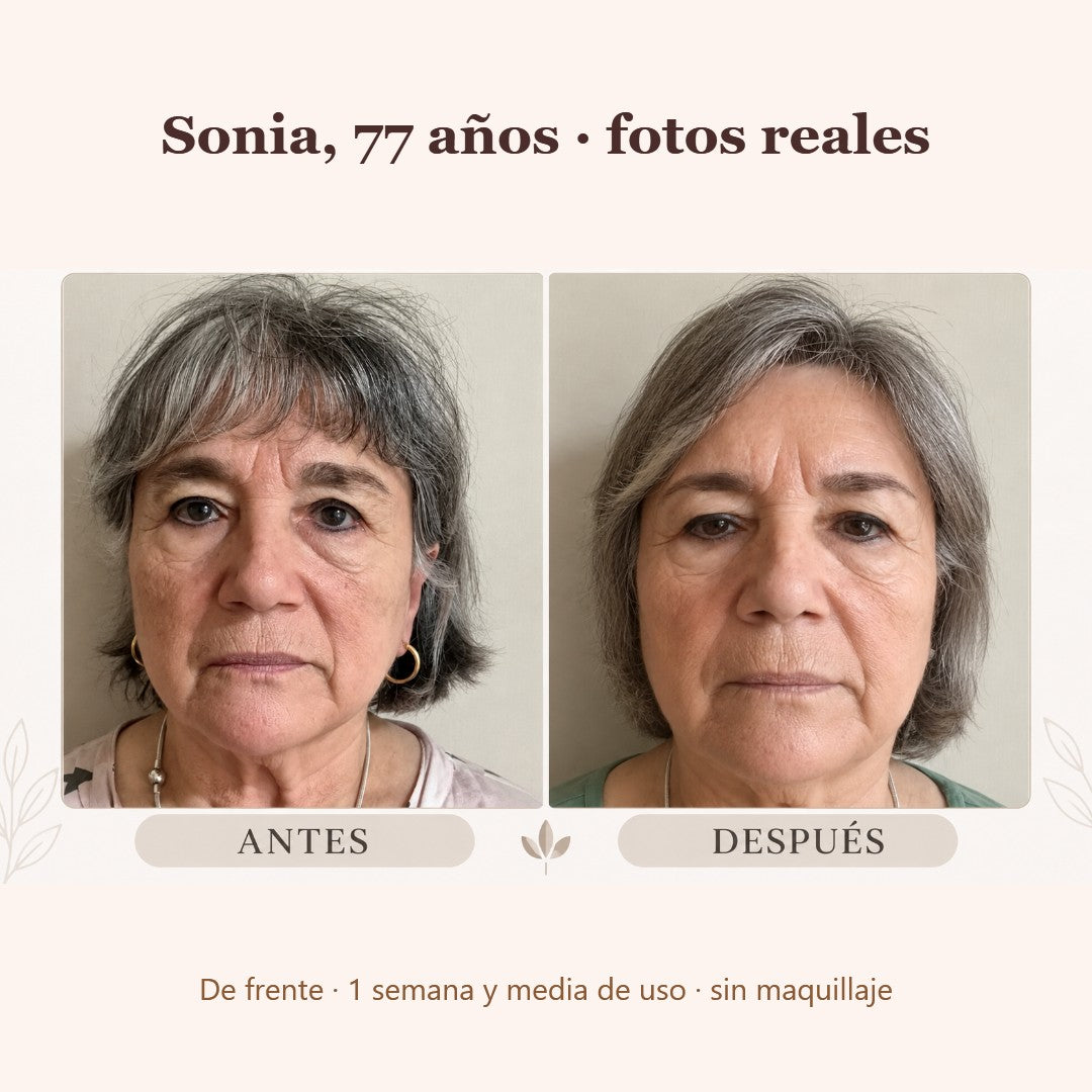 Sonia, 77 años, antes y después de frente