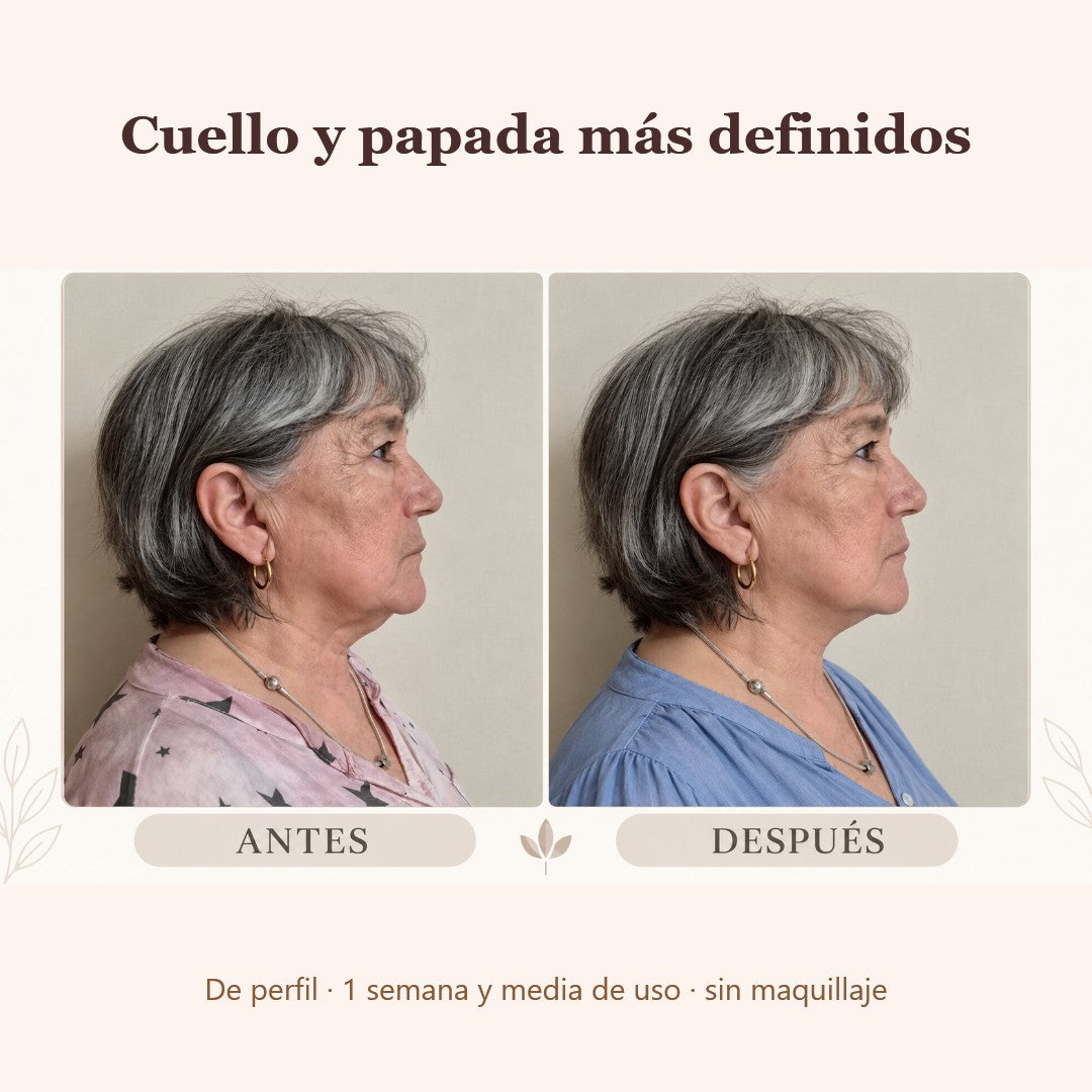Sonia, antes y después de perfil: cuello y papada